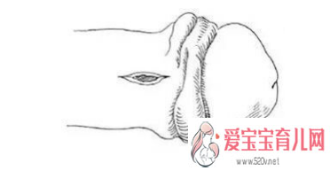 杭州供卵代怀生男孩，龟头嵌顿和正常有什么区别